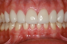 bonding veneer after