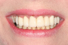 female smile makeover after