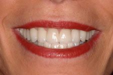 female veneer after