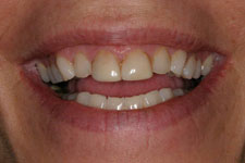 female veneer before