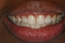 invisalign after