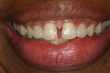 invisalign before