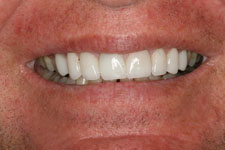 male smile makeover after