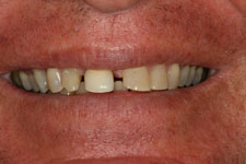 male smile makeover before