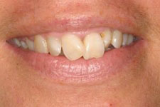 male smile makeover 2 before