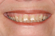 veneers crowns before