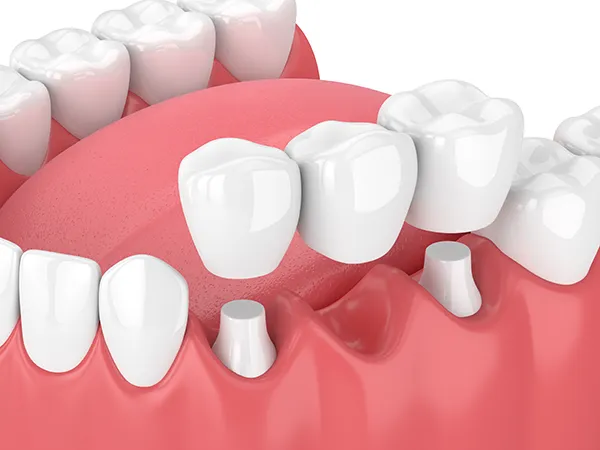 3D rendering of a dental bridge being placed over a missing tooth gap that is flanked by two shaved down teeth